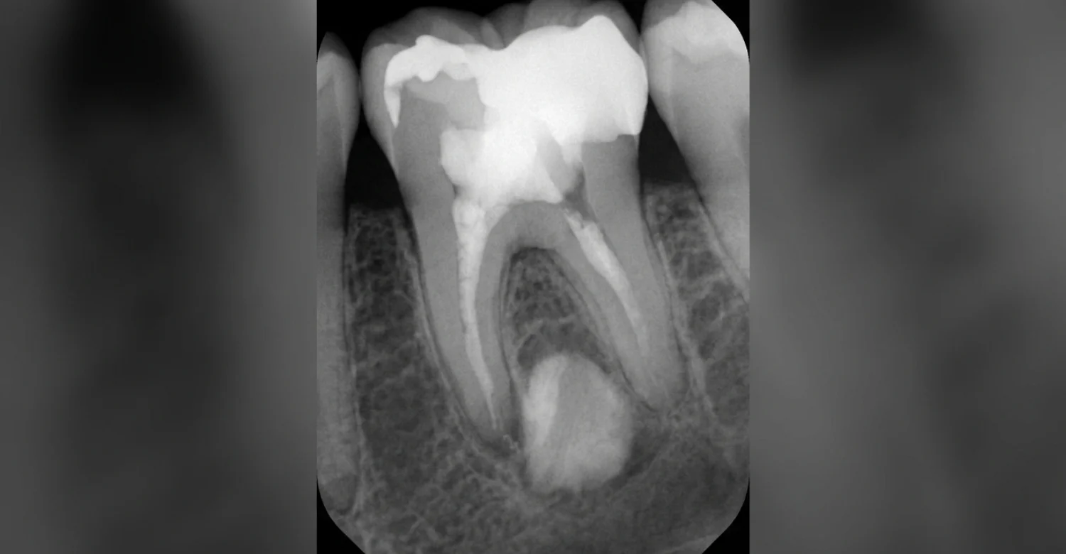 condensing osteitis inblog
